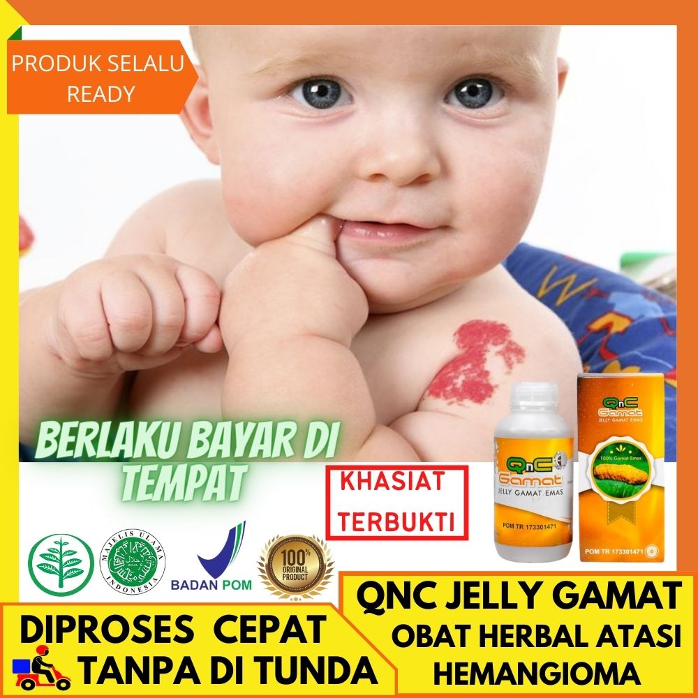 Obat Herbal Hemangioma Untuk Bayi Obat Oles Hemangioma Obat Penyakit