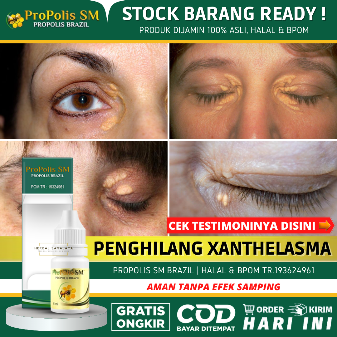 Obat Oles Penghilang Xanthelasma Flak Kekuningan Di Kelopak Mata