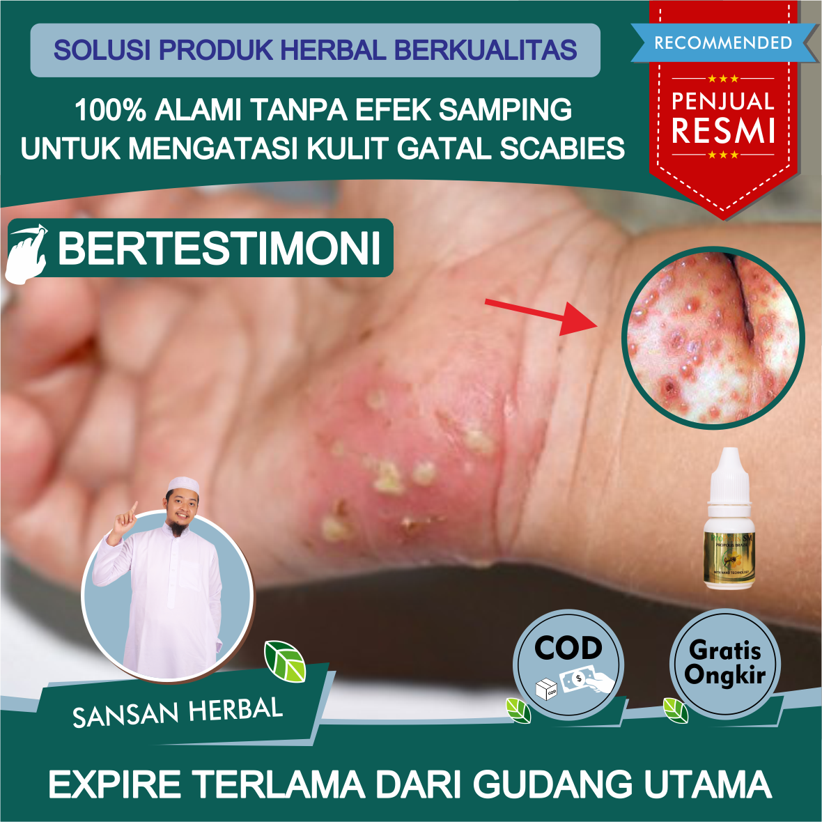 Salep Penghilang Bekas Scabies Salep Jamur Scabies Salep Gatal Karena