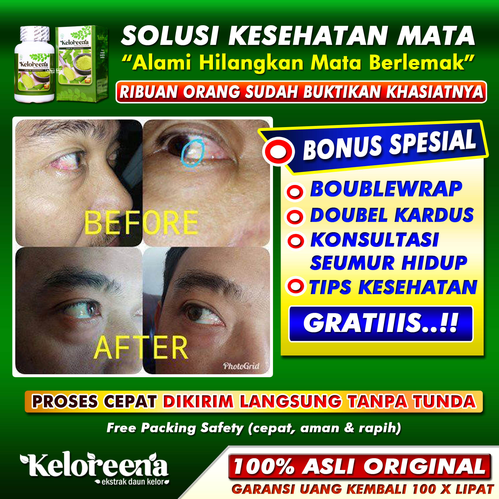 Obat Mata Berlemak Pterigium Selaput Lemak Lamad Pada Bagian Putih