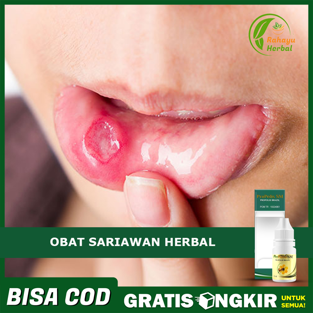 Obat Sariawan Bibir Luka Perih Dan Lecet Obat Menghilangkan Sariawan