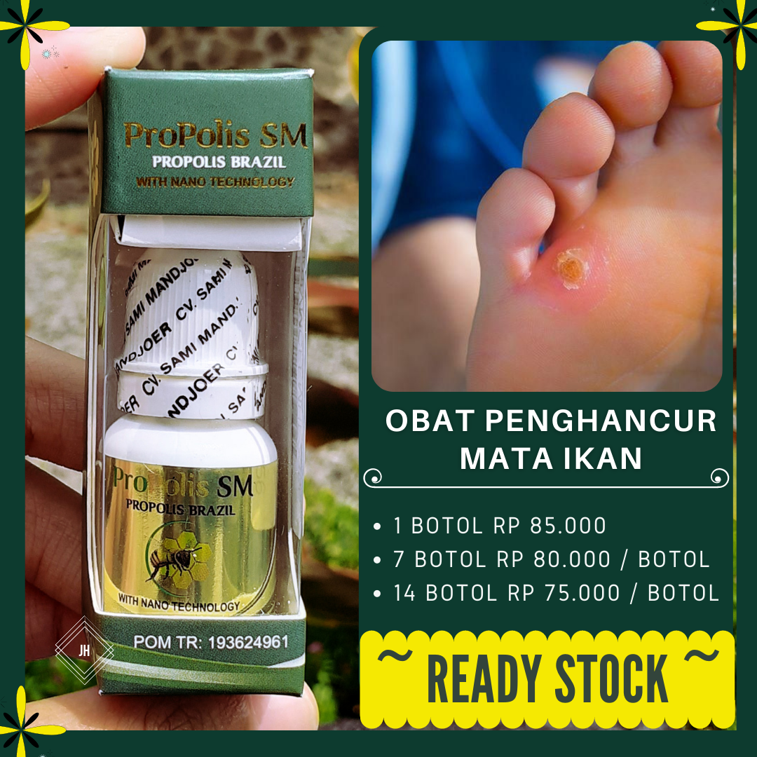 Obat Mata Ikan Di Telapak Kaki Obat Oles Mata Ikan Propolis Sm