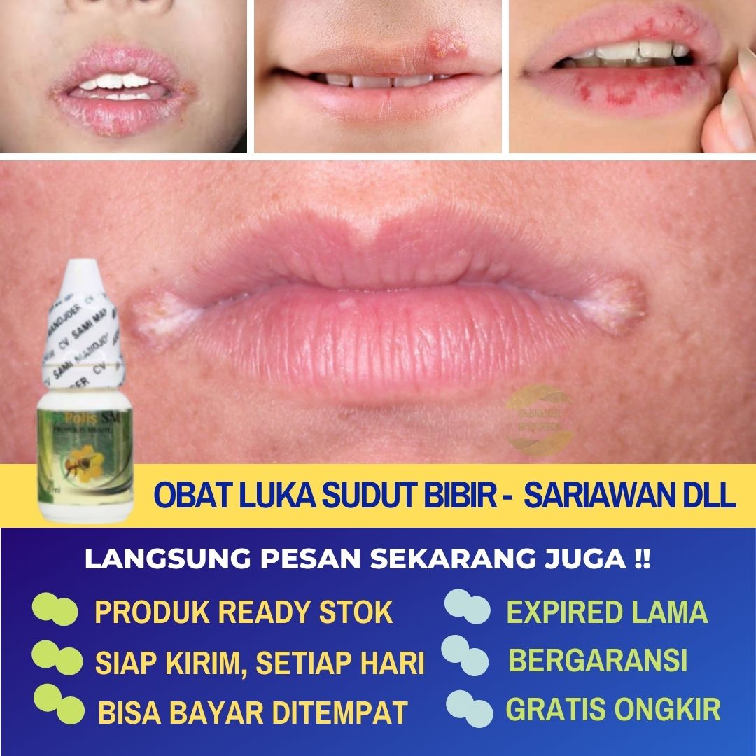 Obat Totoaeun Luka Di Sudut Bibir Pinggir Mulut Luka Angular