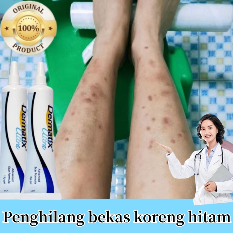 Scar Formula Gel Cream Dermatix Ultra Gel Penghilang Bekas Koreng Lama