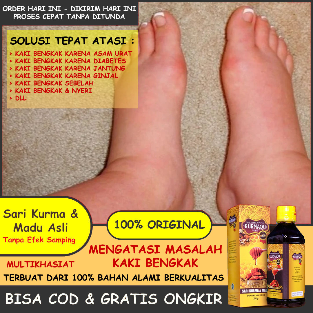 Obat Bengkak Pada Kaki Obat Kaki Bengkak Dan Nyeri Obat Kaki Bengkak