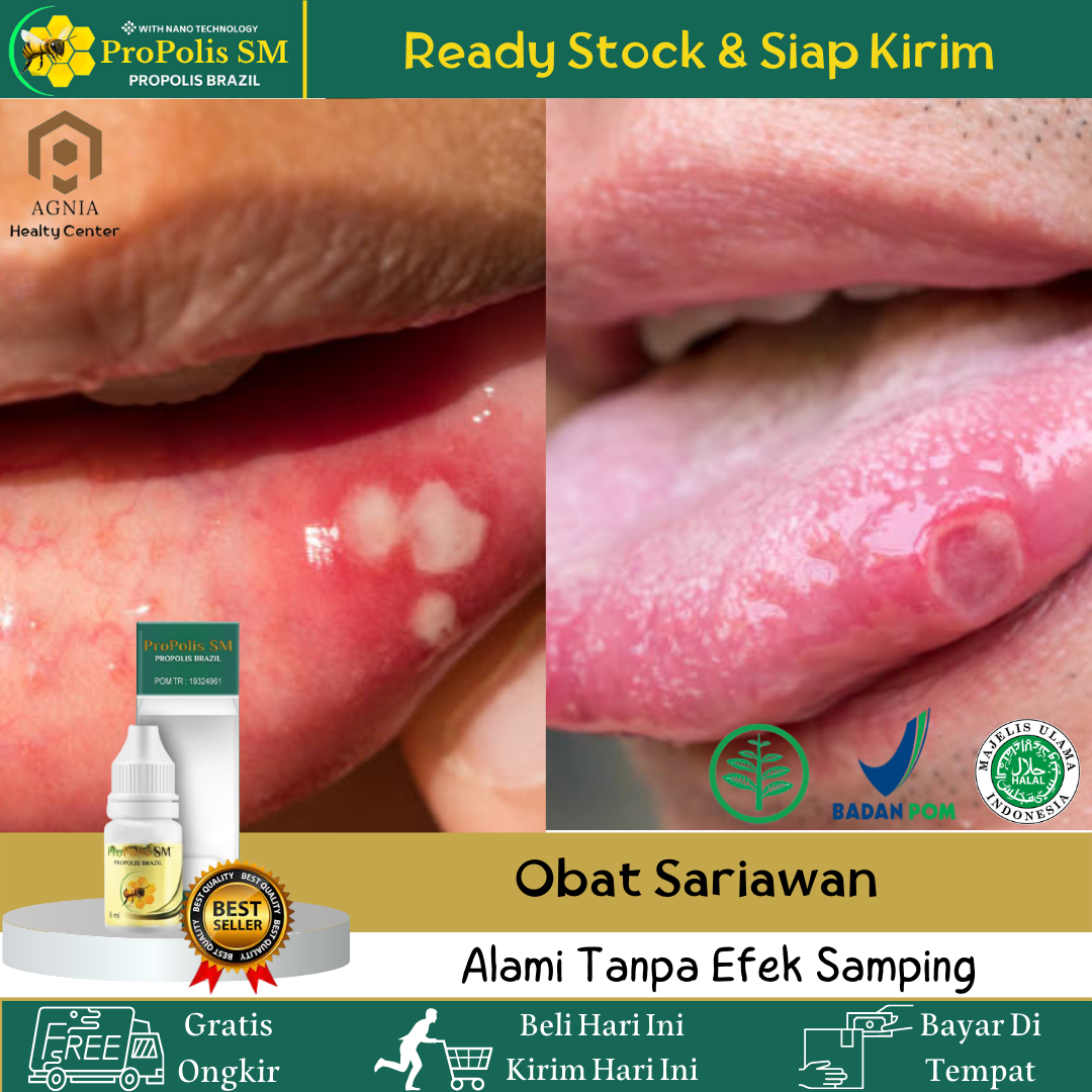 Obat Sariawan Obat Sariawan Di Bibir Obat Sariawan Di Lidah Obat