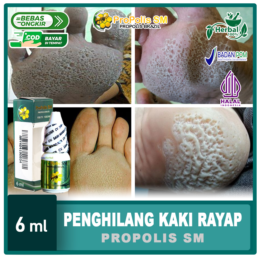 Obat Kaki Rayapan Kutu Air Telapak Kaki Bolong Bolong Dan Bau