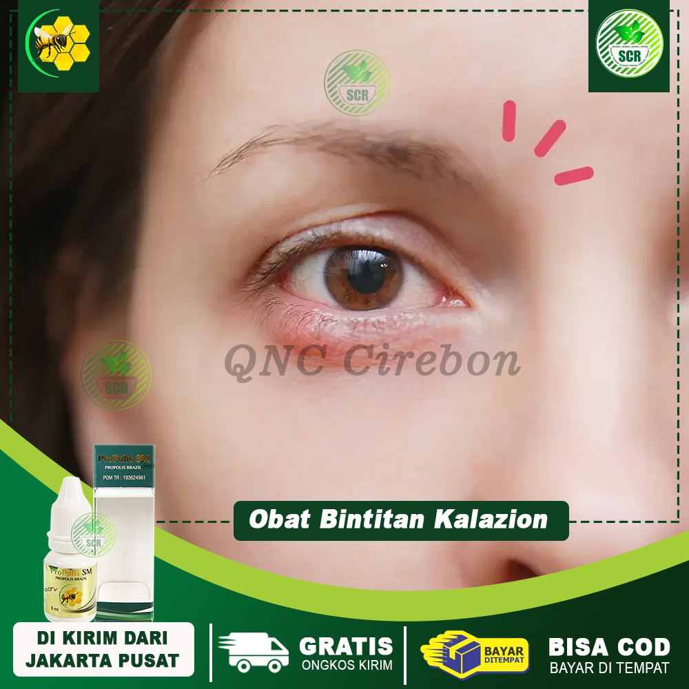 Obat Mata Bintitan Obat Mata Kalazion Benjolan Di Kelopak Mata