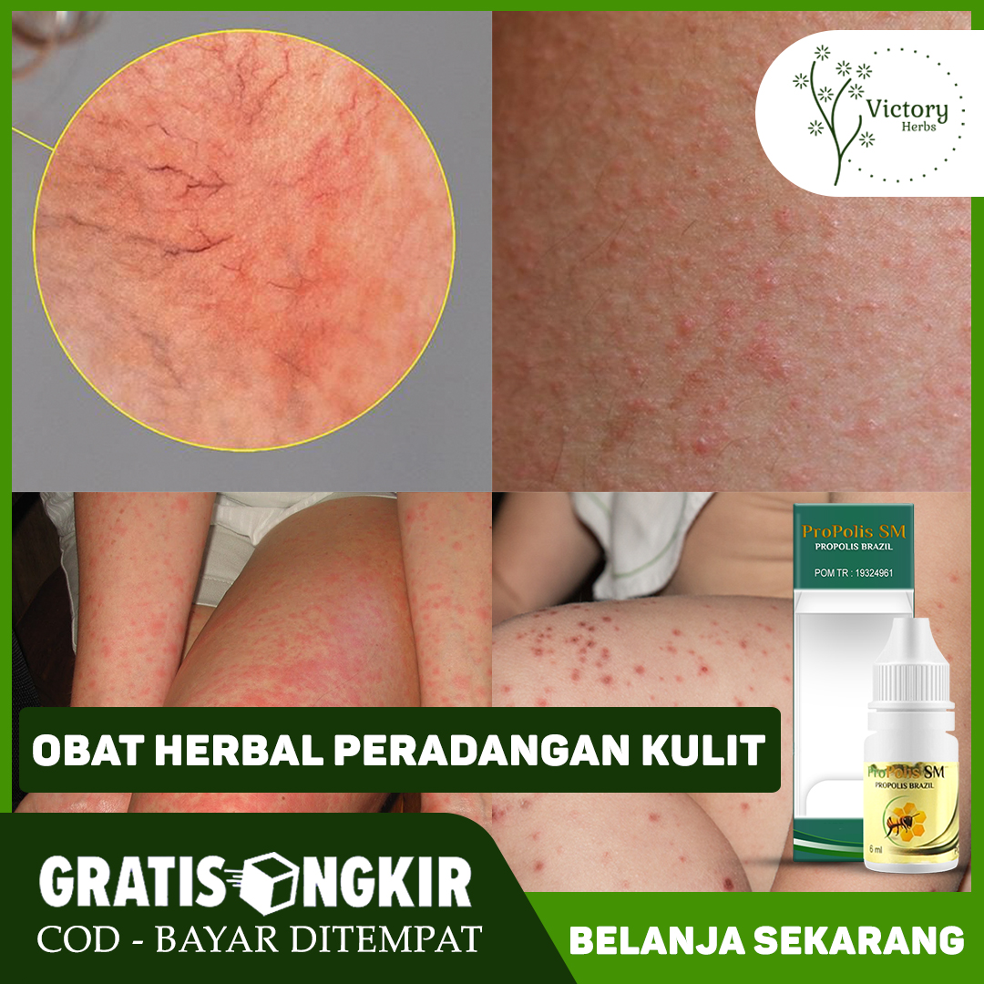 Obat Peradangan Kulit Obat Eksim Eksim Kering Dermatitis Kontak