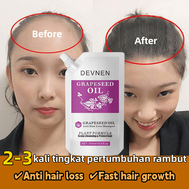 Anti Hair Fall Hair Treatment Shampoo Oil Control Anti Dandruff Anti