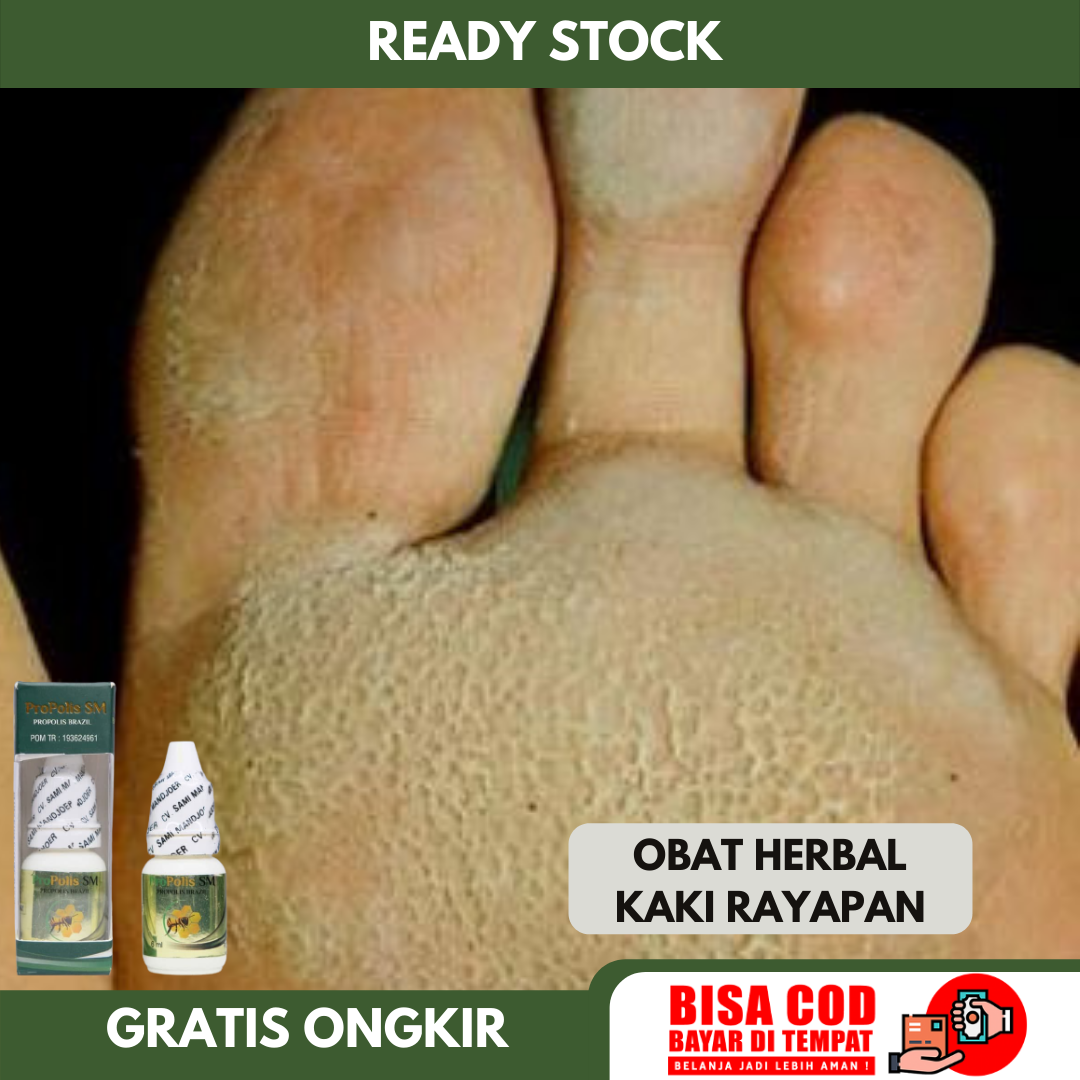 Obat Kaki Rayapan Pitted Keratolysis Obat Telapak Kaki Bolong