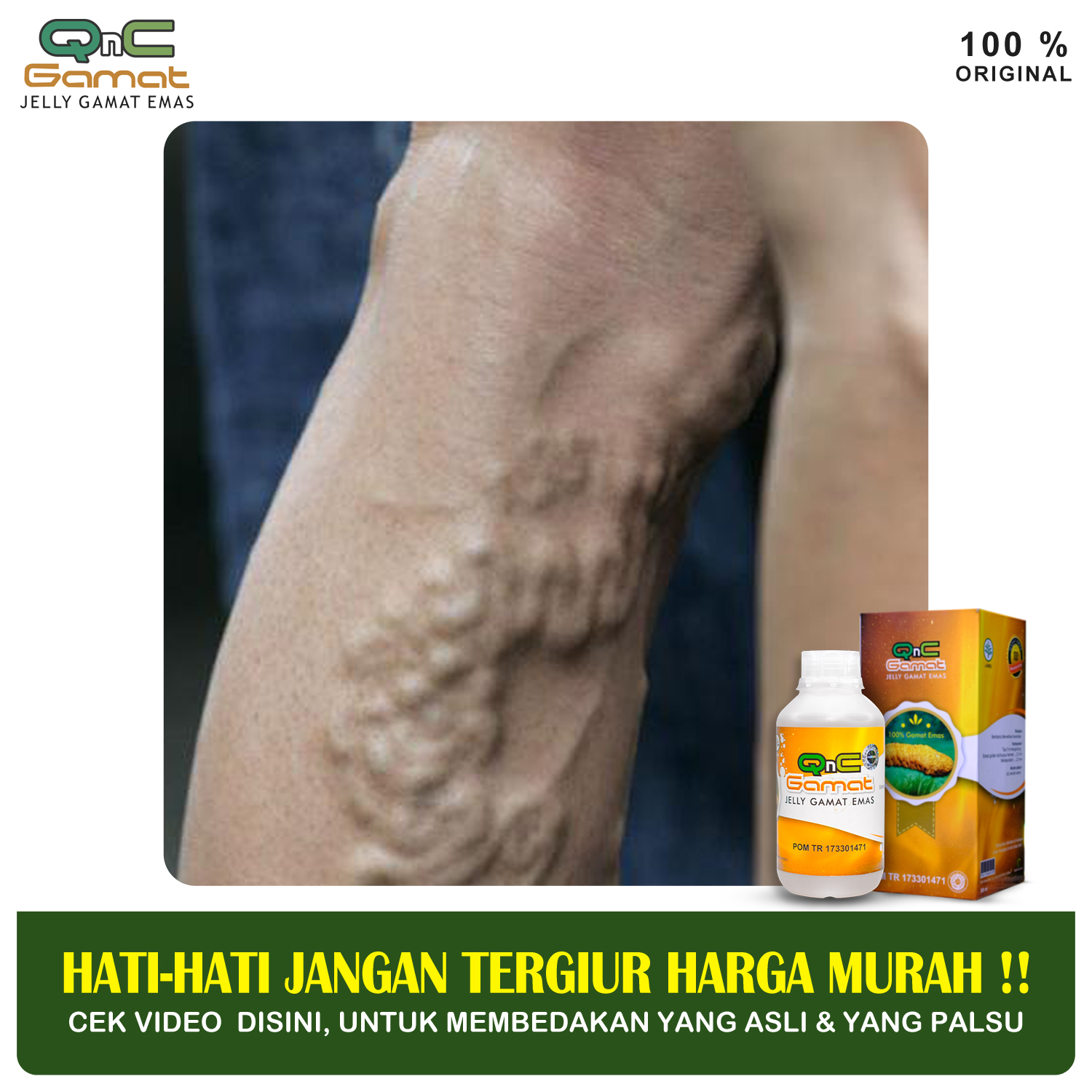 Obat Varises Urat Kaki Varises Betis Varises Telapak Kaki Penyempitan