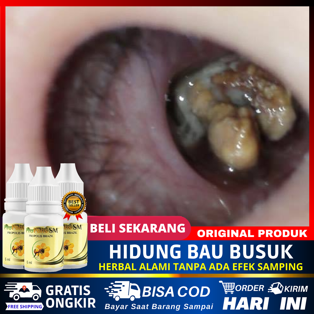 Obat Ingus Bau Busuk Sinusitis Kronis Penghilang Lendir Hidung Bau