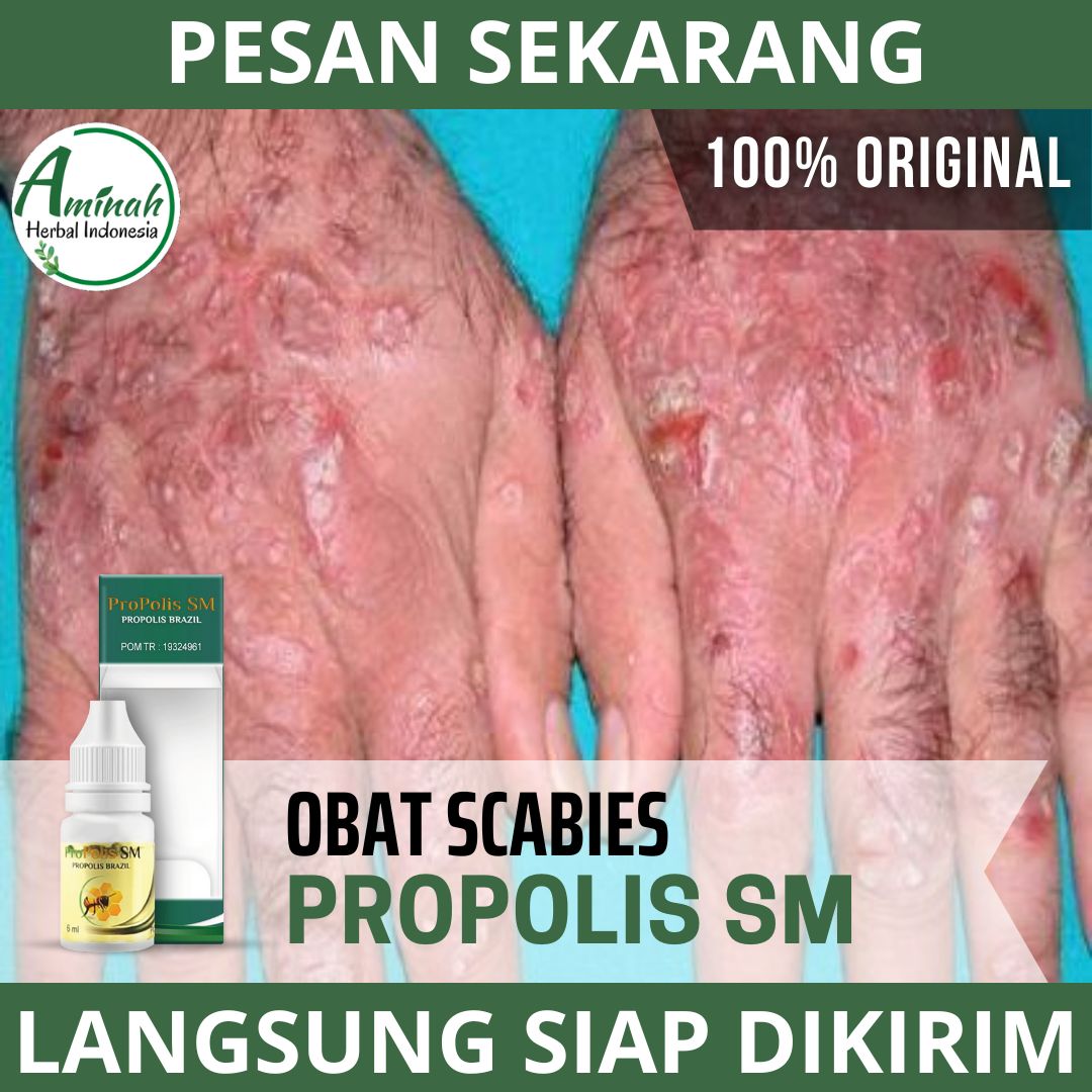 Obat Scabies Obat Gatal Scabies Obat Luka Scabies Obat Scabies Bernanah Obat Scabies Di Kepala