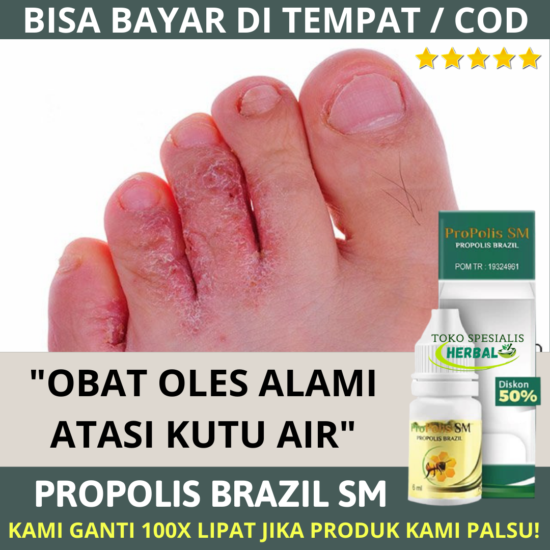 Obat Oles Kutu Air Sela Jari Kaki Gatal Gatel Parah Infeksi Kulit