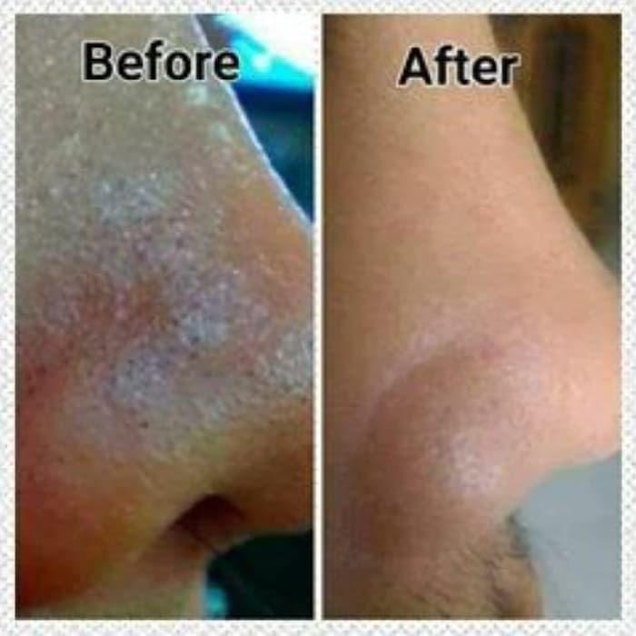 Masker Gelatin Hempas Komedo Bisa Cod Beli 3 Free 1 Spatula Masker Gelatin Hempas Komedo 30gr Masker Komedo Masker Wajah Murah Lazada Indonesia