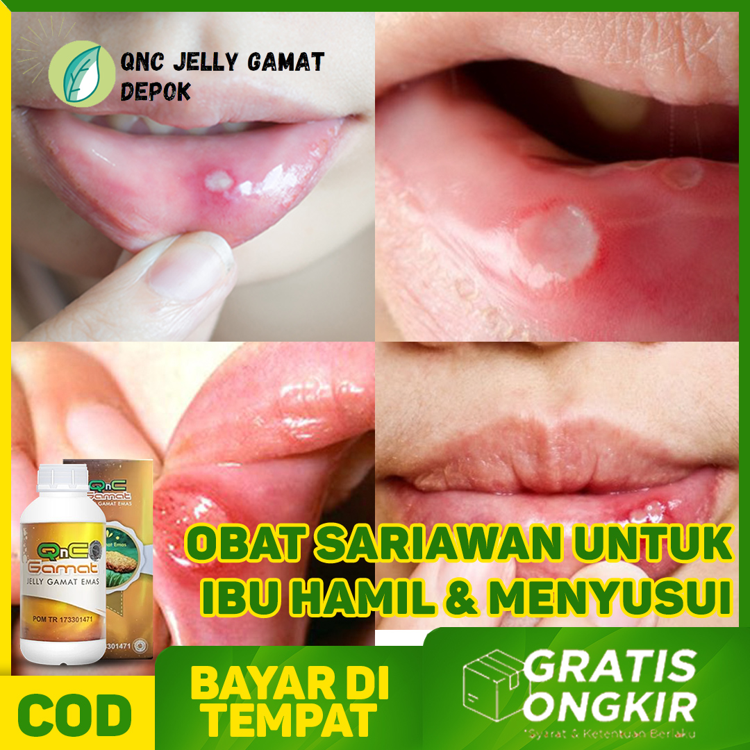 Obat Sariawan Untuk Ibu Hamil Dan Menyusui Obat Panas Dalam Bibir Pecah Pecah Qnc Jelly Gamat Original Tanpa Epek Samping Lazada Indonesia