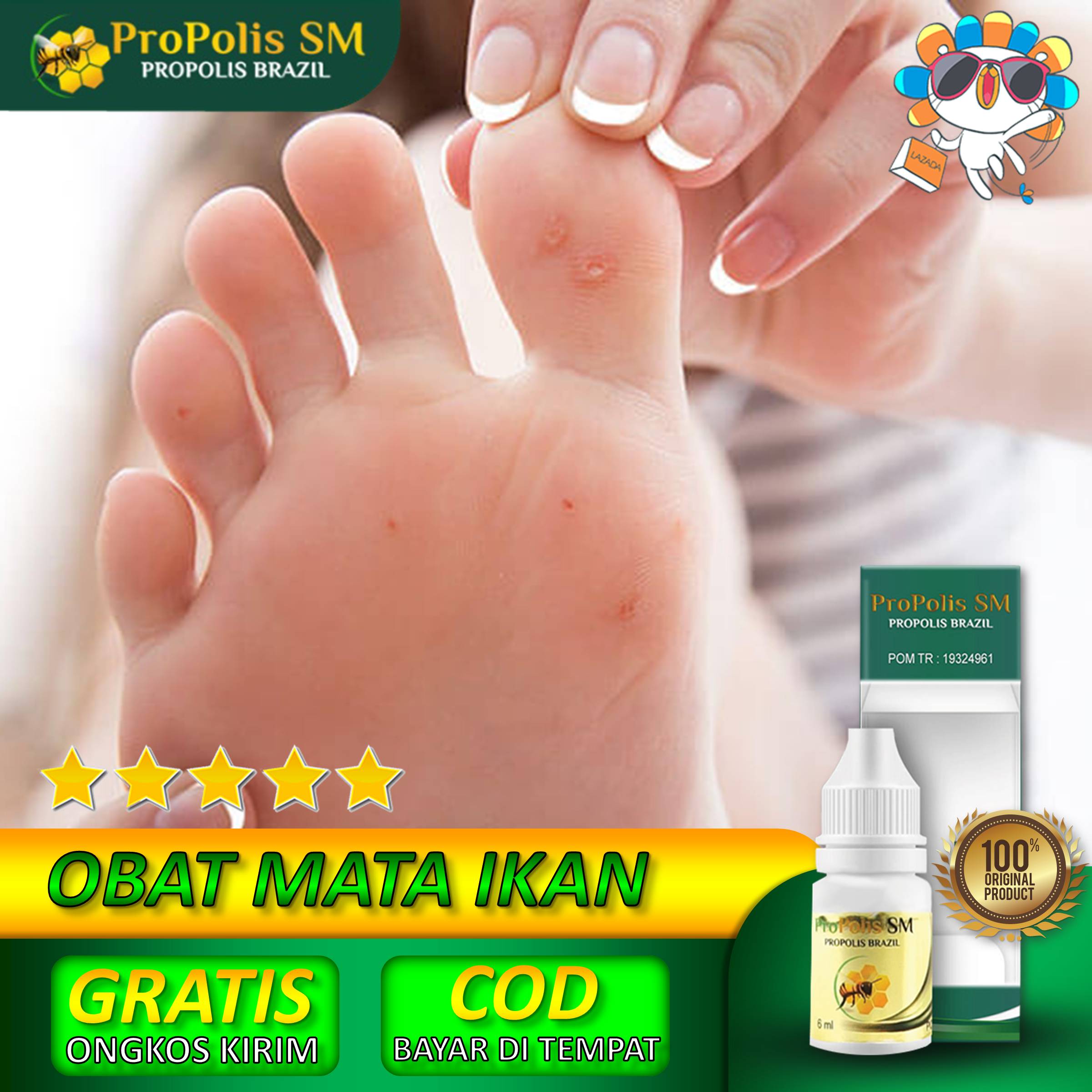 Obat Mata Ikan Alami Obat Herbal Mata Ikan Di Kaki Anak Dewasa Bobotoleun Obat Mata Ikan Hingga Ke Akarnya Klavus Mata Ikan Di Jari Dan Telapak Kaki Kutil Plantar Di