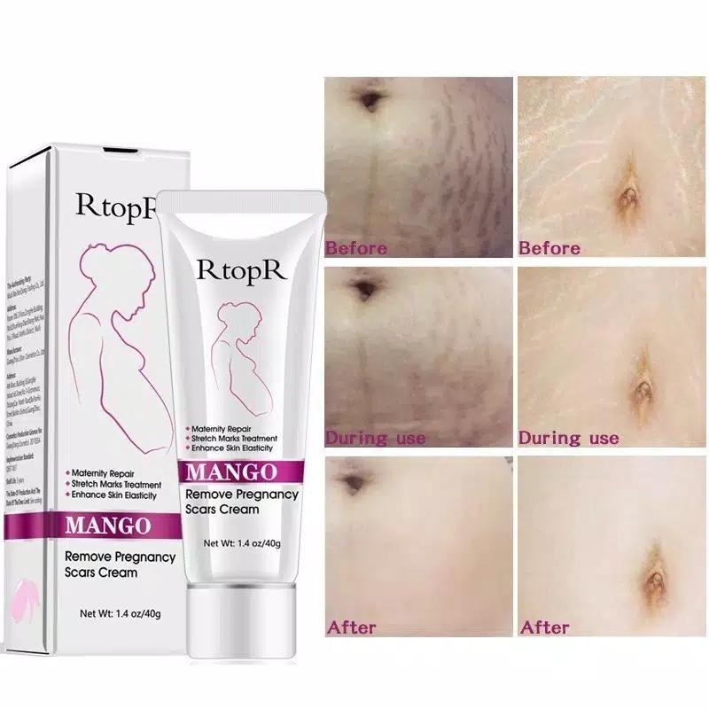 Jual Cream Stretch Mark Untuk Ibu Hamil Terbaru Lazada Co Id