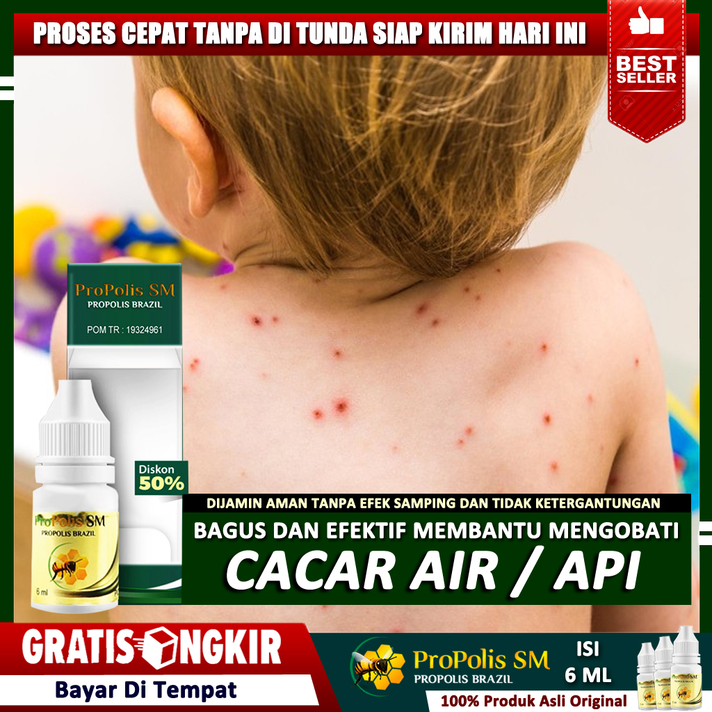 Obat Cacar Anak/Dewasa - Cacar Air, Cacar Api, Penghilang Bekas Cacar ...