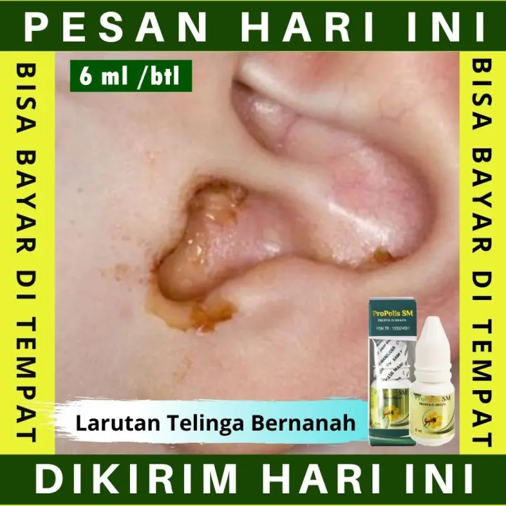 Obat Tetes Buat Mencegah Penimbunan Nanah Alami Obat Cair Telinga Bernanah Ssb Obat Cairan Untuk Telinga