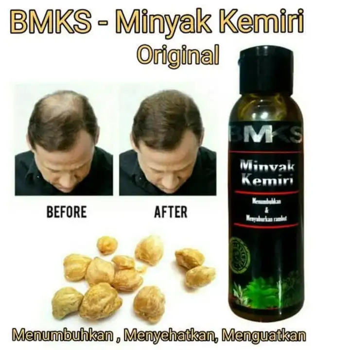 Minyak Kemiri Penumbuh Rambut Original 100 Asli Kemiri Obat Penumbuh Rambut Aman Untuk Bayi 100ml