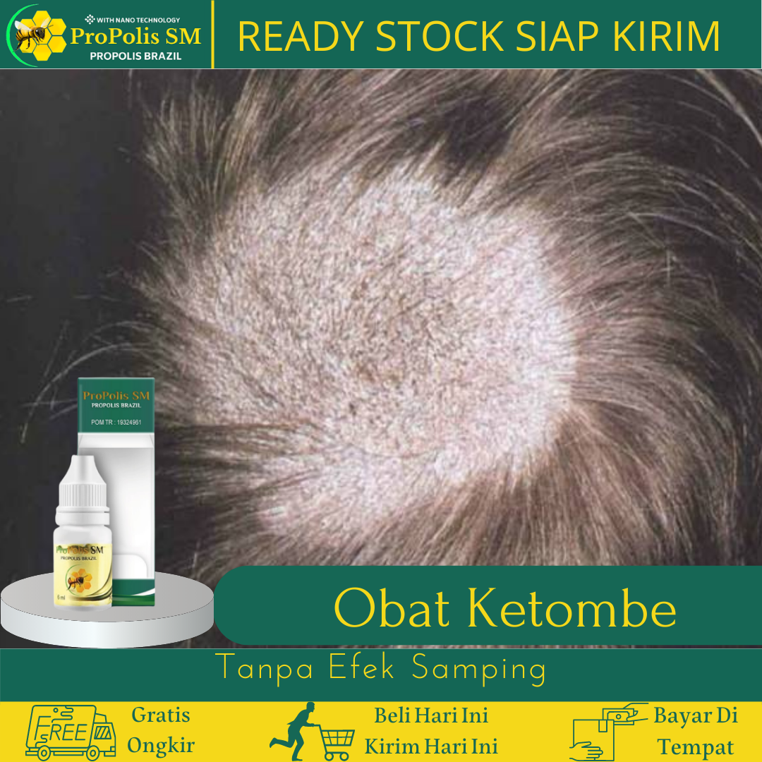 Obat Untuk Tetes Ketombe, Obat Untuk Kulit Kepala Kering Dan Berkerak