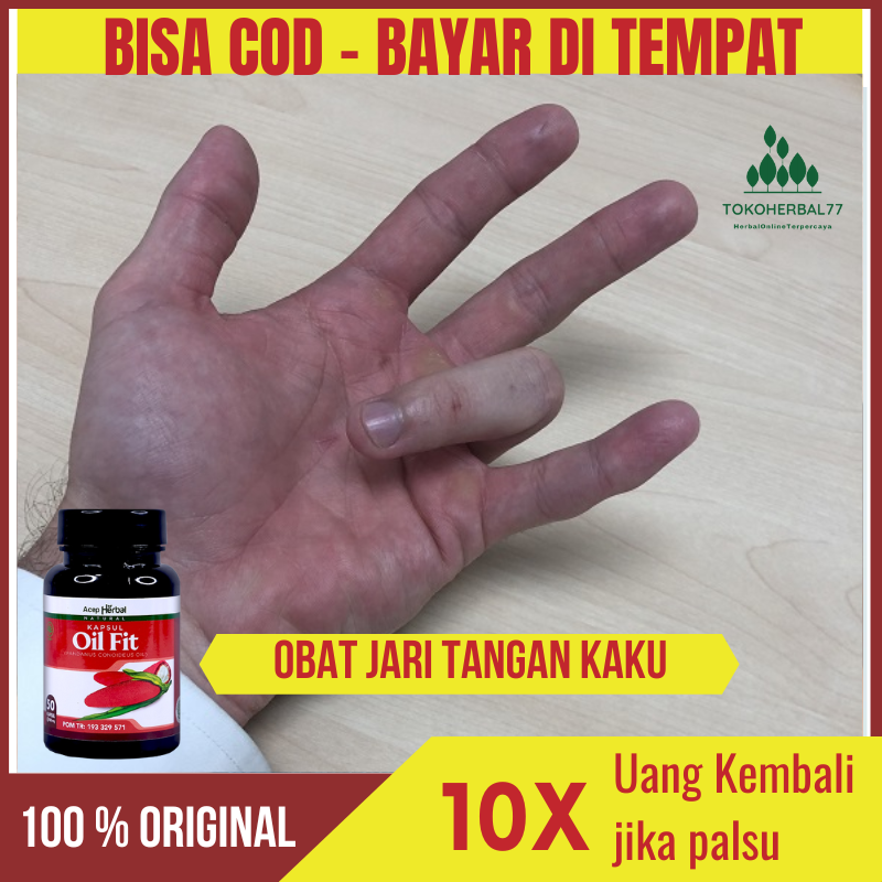 Kapsul Oil Fit Obat Jari Tangan Kaku Sakit Dan Kesemutan Trigger Finger Ngilu Susah Di