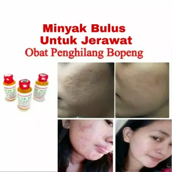 Penghilang Bopeng Jerawat Anti Keriput Minyak Bulus Original Pengencang Pembesar Payudara Lazada Indonesia