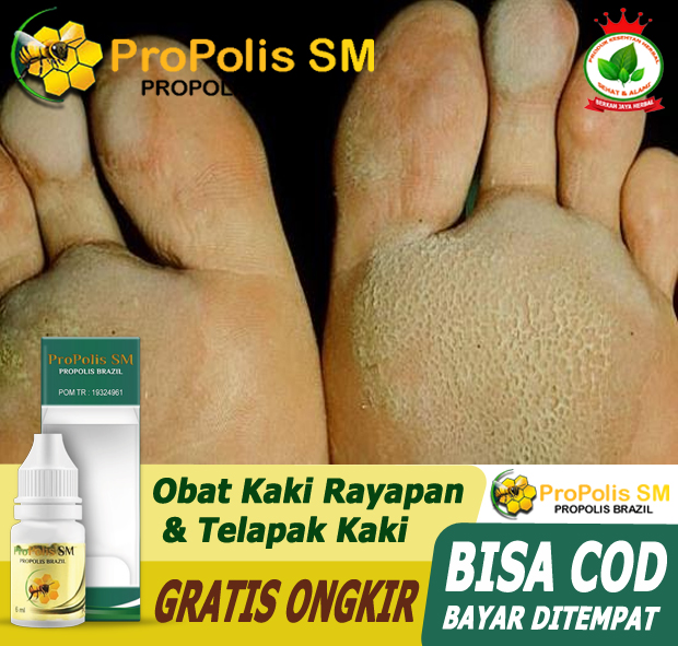29+ Cara mengobati kaki rayapan dengan bawang putih ideas