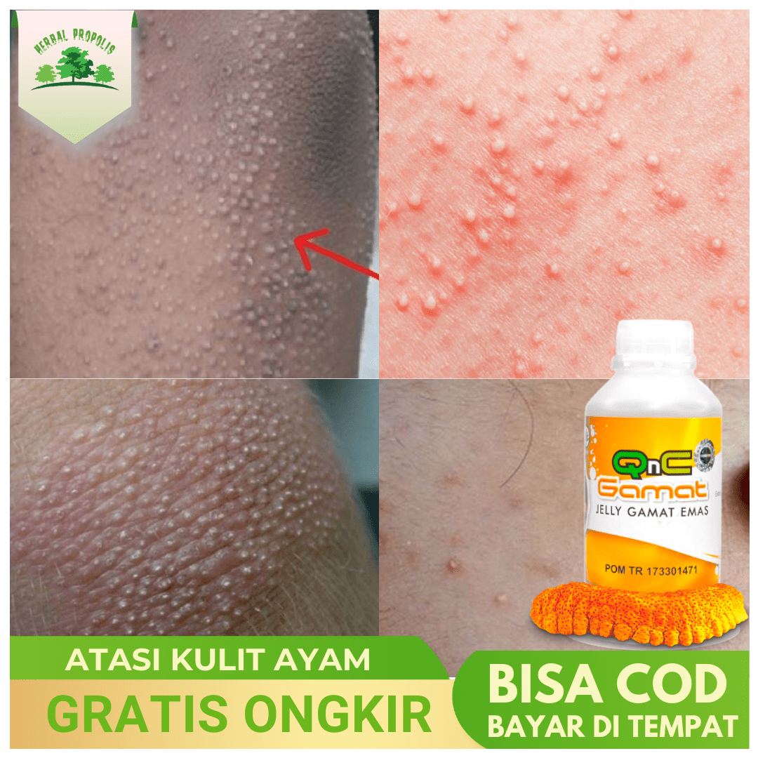 Obat Penyakit Kulit Ayam Keratosis Pilaris Penghilang Kulit Kasar