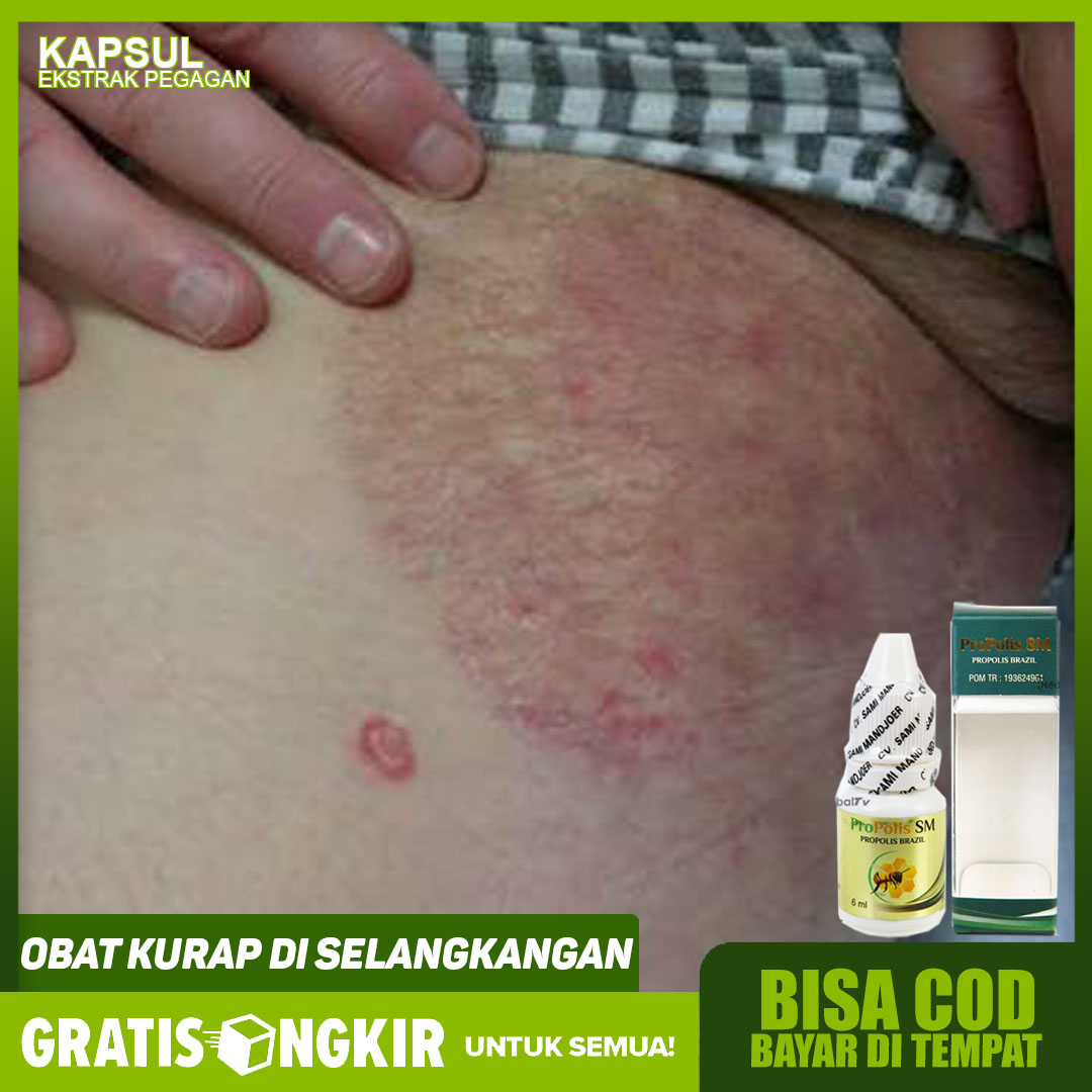 Obat Kurap Di Selangkangan Obat Panu Jamur Kulit Propolis Lazada Indonesia
