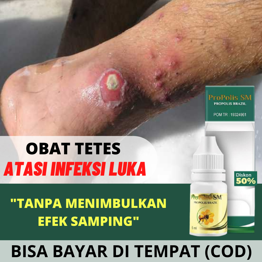 Penyebab Jari Tangan Bengkak Dan Cara Mengatasinya Alodokter
