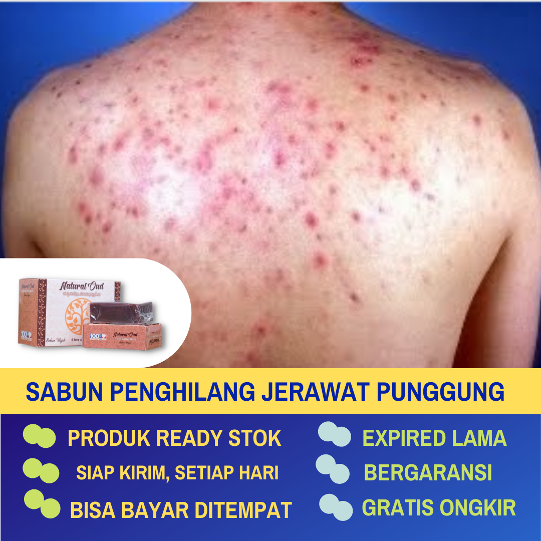 Penghilang Jerawat Punggung Pria dan Wanita, Sabun Buat Jerawat Di Punggung, Pembersih Jerawat