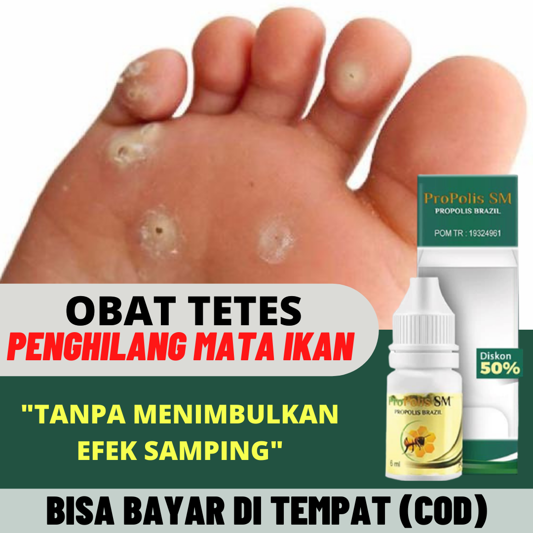 Obat Herbal Penghilang Mata Ikan Obat Mata Ikan Obat Kapalan Obat Mata Ikan Di Kaki Obat