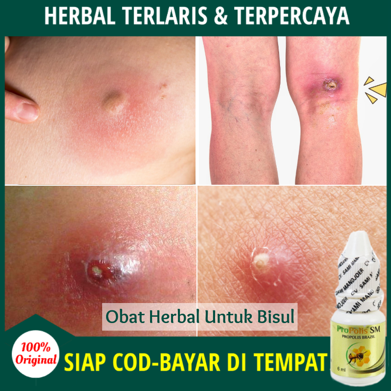 Obat Bisul Tradisional Obat Bisul Bernanah Berdarah Abses Perianal Obat Benjolan Bisul Di Pantat Anus Miss V Obat Herbal Alami Bisulan Obat Oles Bisul Di Ketiak Pusar Salep Untuk