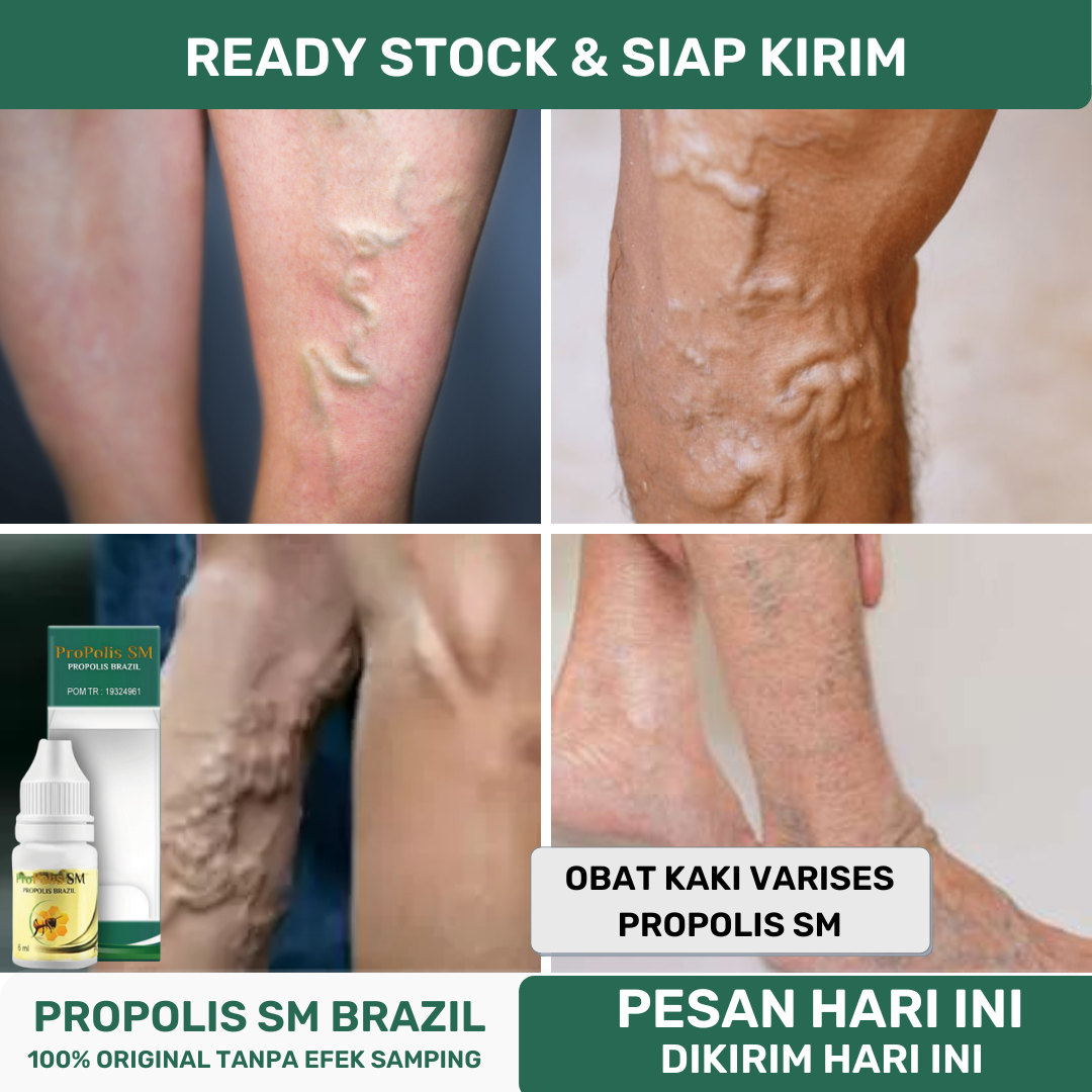 Obat Kaki Varises, Obat Penyakit Varises, Obat Nyeri Varises, Obat