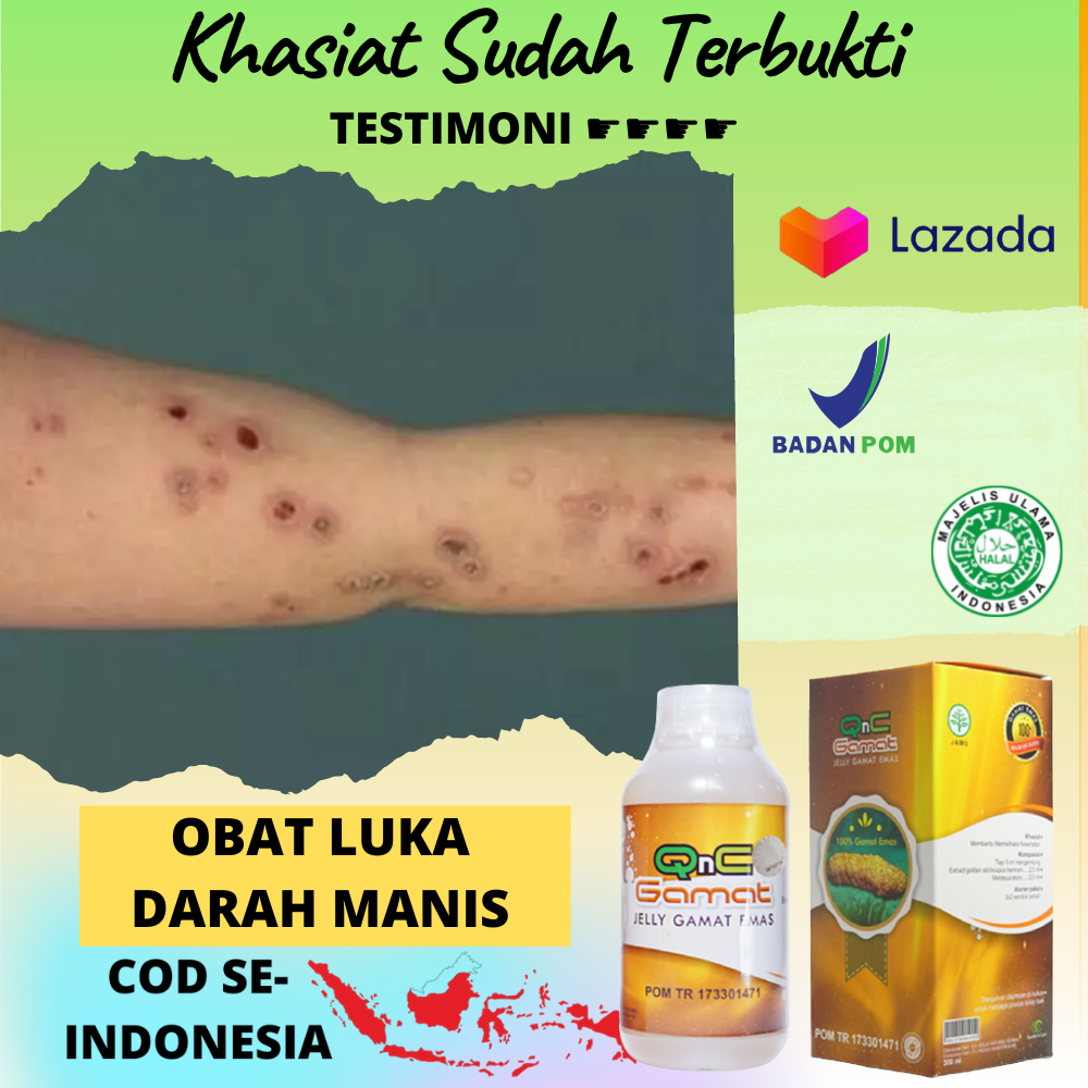 Obat Darah Manis Luka Prurigo Koreng Korengan Borok Berlubang Luka 