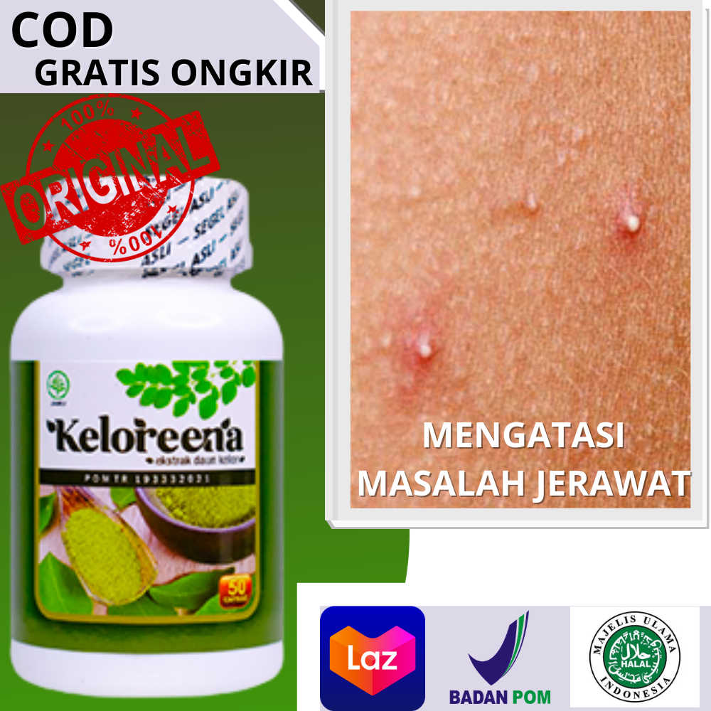 Cara Mengatasi Jerawat Papula