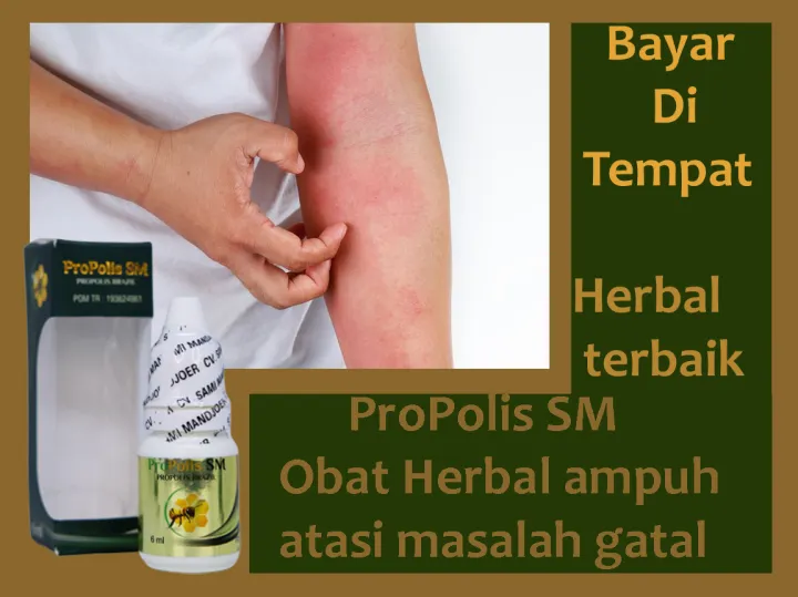 Obat Gatal Cara Mengatasi Gatal Cara Menghilangkan Rasa Gatal Obat Gatal Kepala Obat Gatal Bekas Gigitan