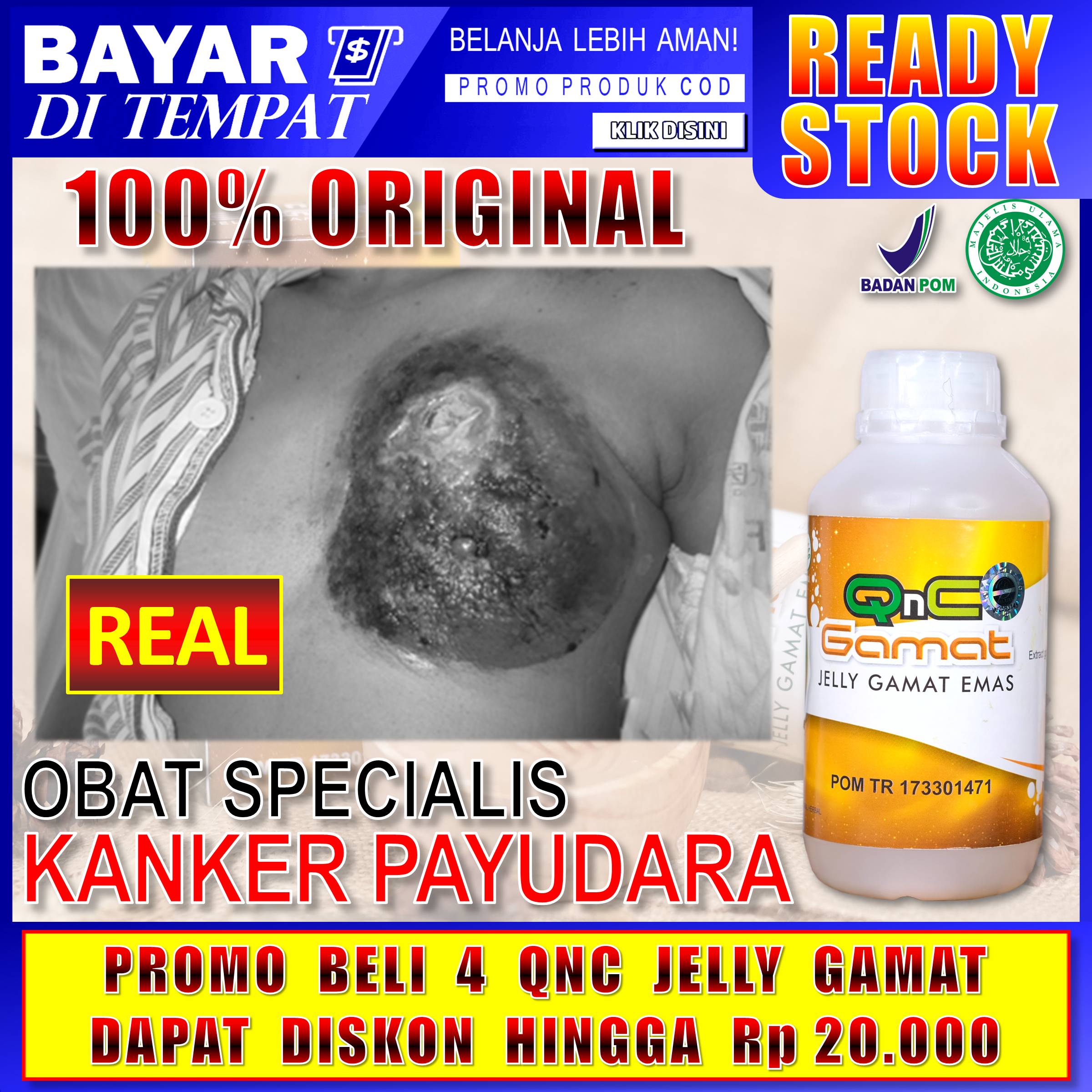 Obat Oles Luka Kanker Payudara Udah Meletus Alami Obat Herbal Tumor Jinak Dan Ganas Di Payudara Menahun Puting Susu Bernanah Bisa Untuk Wanita Dan Pria Tanpa Efek Samping Dokter Luka Basah Kering