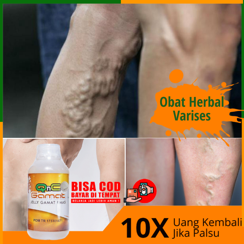Obat Penghilang Varises Penumpas Varises Di Kaki Tangan Betis Perut Wajah Dan Testis Penghilang Varises Bengkak Parises Obat Hilangkan Varises Varises Esofagus Obat Kaki Bengkak Varises Pembuluh Darah Vena Pecah Dgn