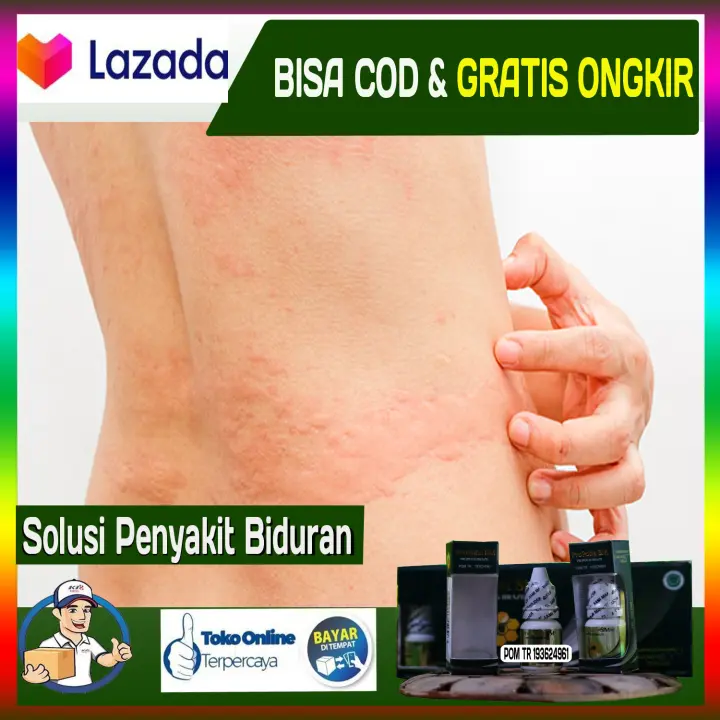 Obat Biduran Herbal Alami Propolis Sm 100 Asli Tanpa Efek Samping Obat Biduran Akut Kronis