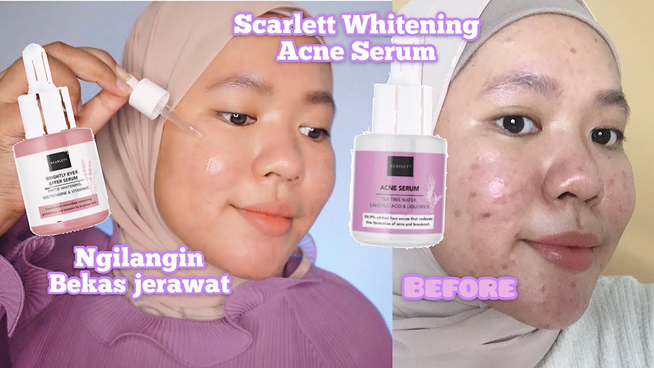 testi serum acne scarlett