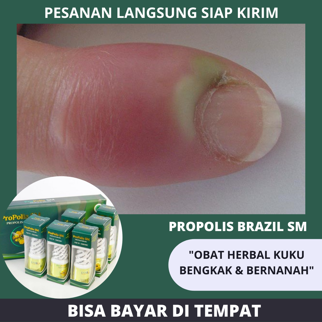 Obat Kuku Tangan Bengkak Dan Bernanah Obat Cantengan Jari Tangan Obat Infeksi Kuku Tangan Obat Nyeri Jari Tangan Obat Jamur Kuku Obat Jari Bengkak Obat Jari Bernanah Dengan Propolis Brazil Sm