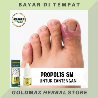 Obat Cantengan Obat Cantengan Jempol Kaki Obat Cantengan Tangan Obat Cantengan Parah Obat Cantengan Kaki Obat Cantengan Herbal Obat Jempol Kuku Cantengan Obat Kuku Cantengan Dengan Propolis Sm Lazada Indonesia