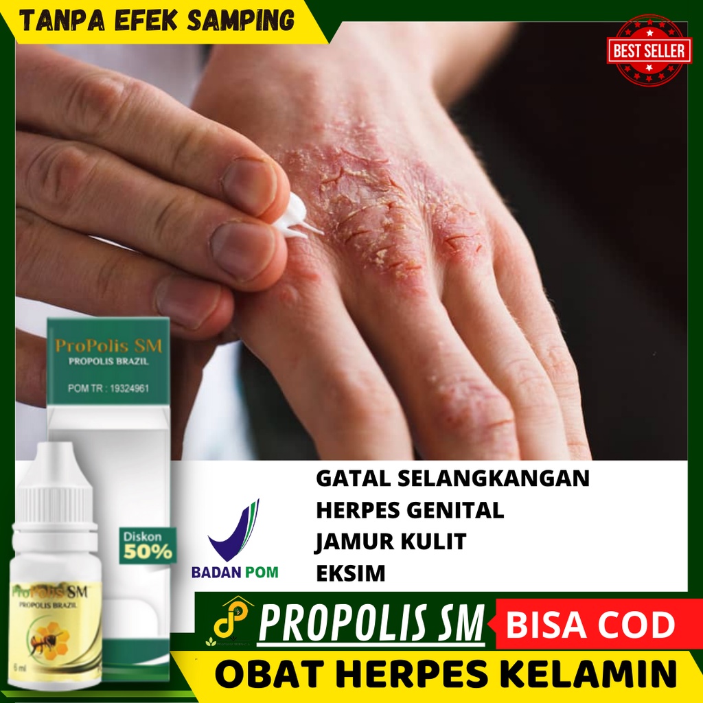 Cara Menghilangkan Kurap Sampai Ke Akarnya Seperti Kadas Kurap Yang