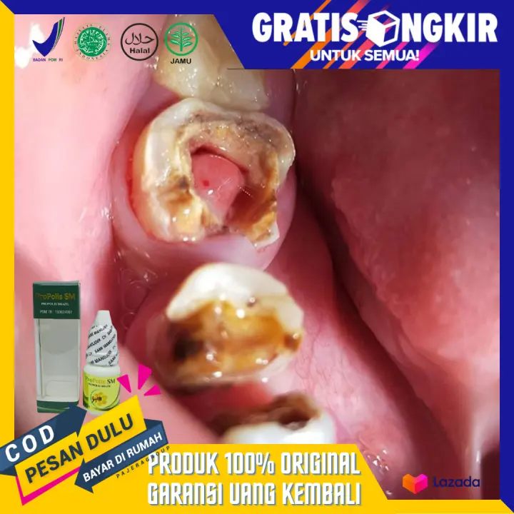 Bisa Cod Obat Polip Gigi Herbal Polip Pulpa Obat Polip Gigi Obat Merontokan Polip Gigi Benjolan Bisa Cod Obat Polip Gigi Herbal Polip Pulpa Obat Polip Gigi Obat Merontokan Polip Gigi Benjolan