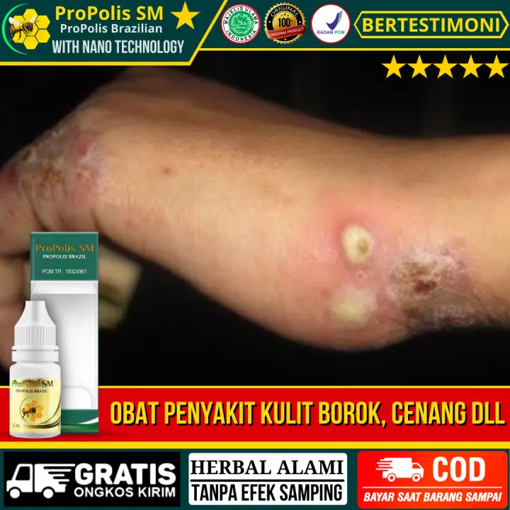 Jual Obat Penyakit Psoriasis Kulit Bersisik Kulit Kering Penyakit Kul Jakarta Selatan Reepsart Tokopedia