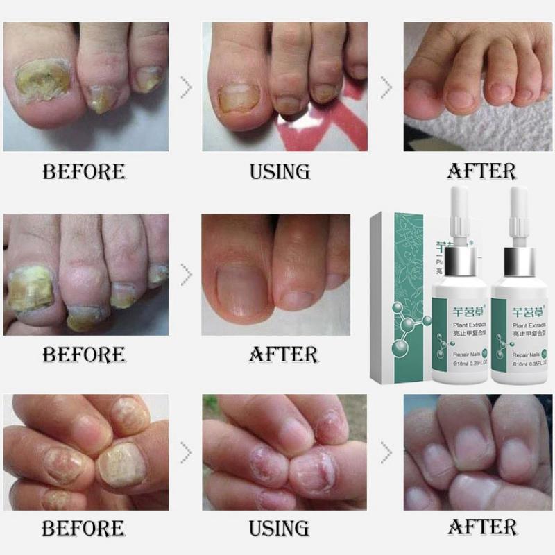 Seaflaker Nail Kháng Khuẩn Lỏng Trị Nấm Móng Tay Chăm Sóc Móng Nuôi Dưỡng Hiệu Quả Chống Lại Móng Tay Và Chăm Sóc Bàn Chân